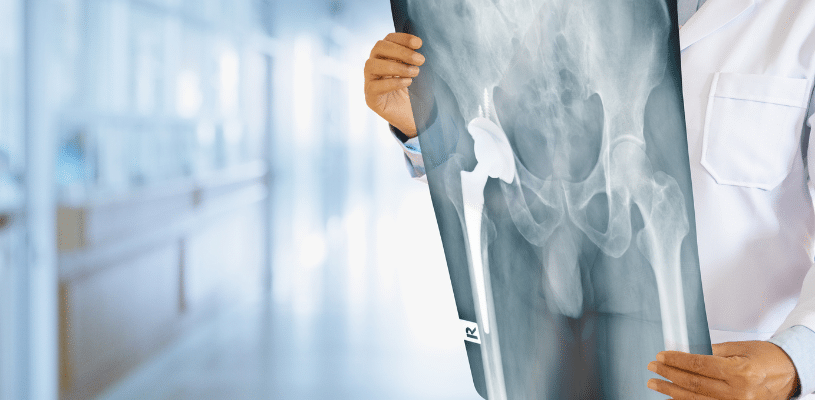 A person in a white lab coat holds an X-ray of hip bones.