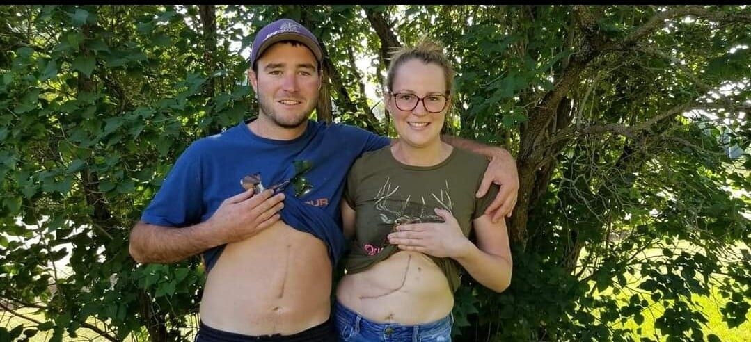 A young man and woman show their transplant scars on their stomachs.